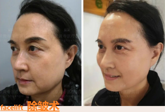 小切口拉皮手术到底是什么？