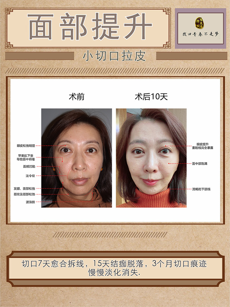 面部衰老的三个阶段