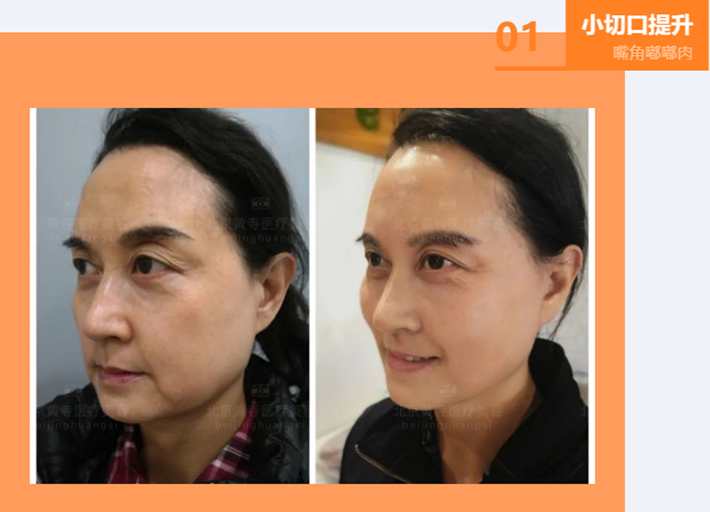 “婴儿肥”变成了“嘟嘟肉”该怎么办？
