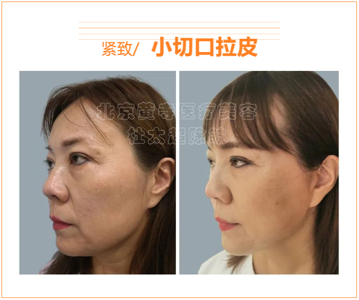 为什么现在都做小切口拉皮？