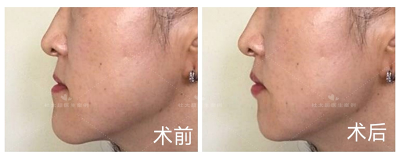 填充材料的利弊