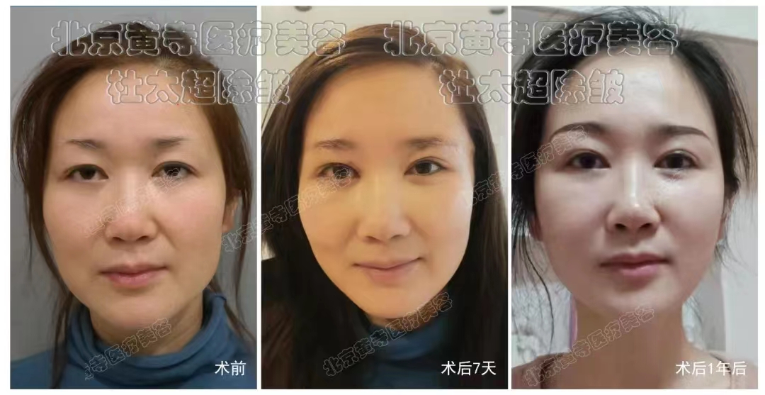 提眉手术详解