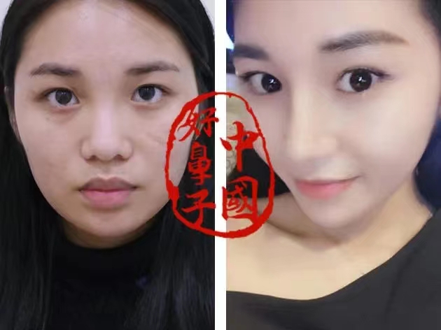 鼻整形并不是女性求美者的专利！