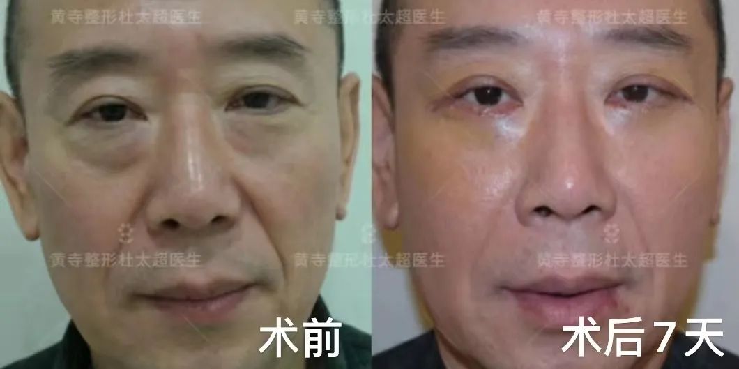 眼袋的形成原因及常见的处理方式