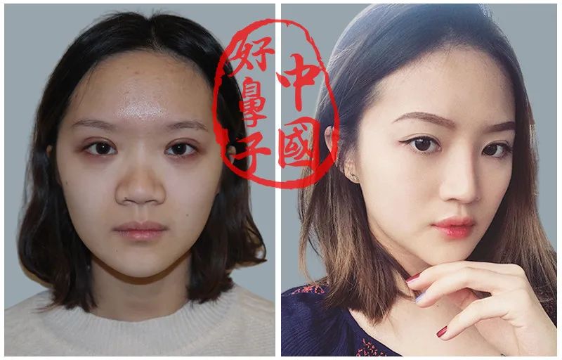 招人嫌的“蒜头鼻”