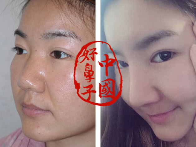 鼻部整形的两个标准您知道吗？