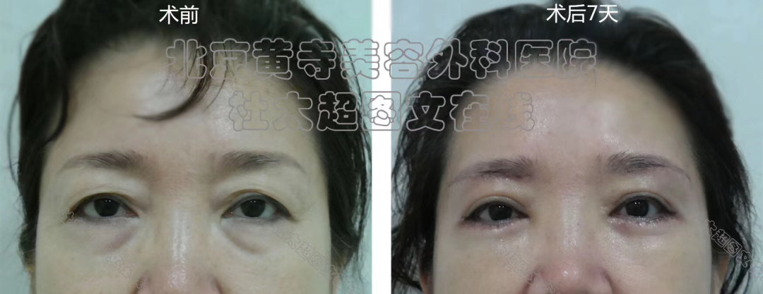一次祛眼袋手术效果到底可以维持多久？