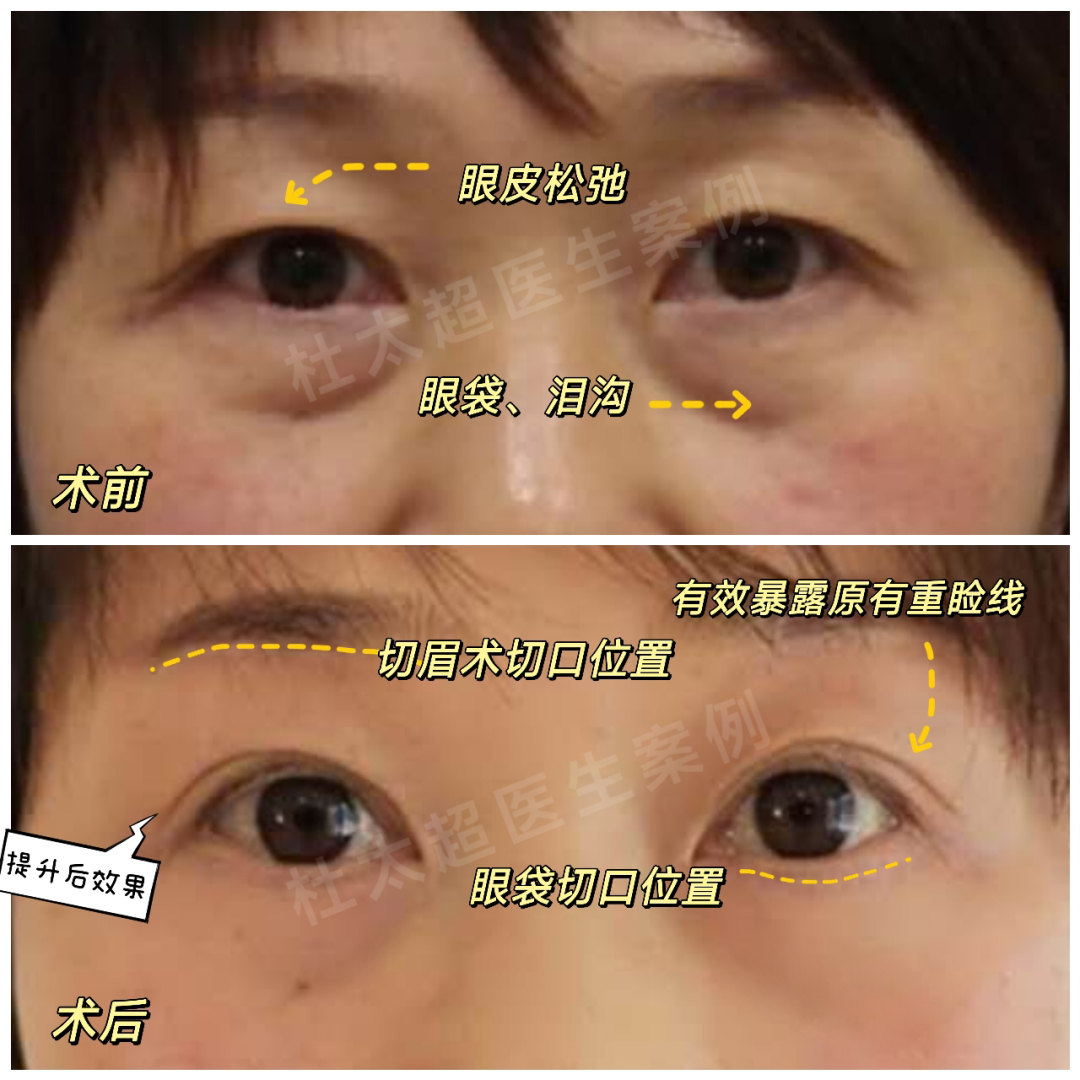 什么原因导致眼袋术后疤痕增生？
