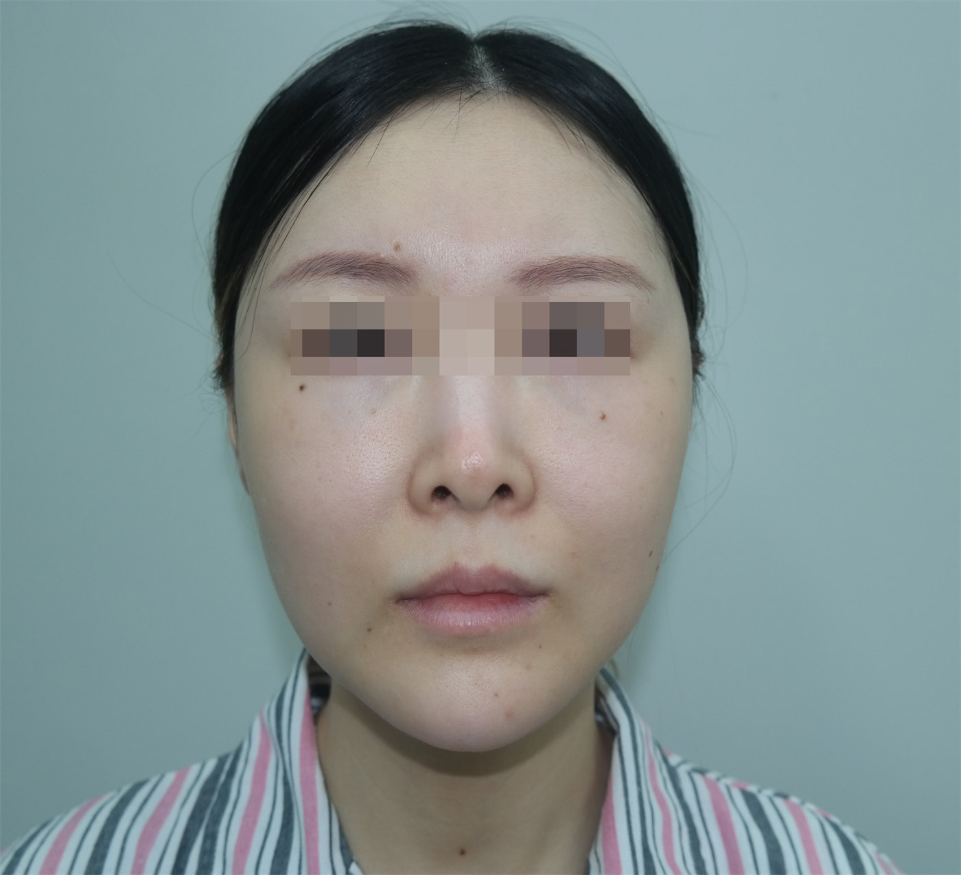 36岁女士拉皮全程记录，术后7天减龄、少女感十足！