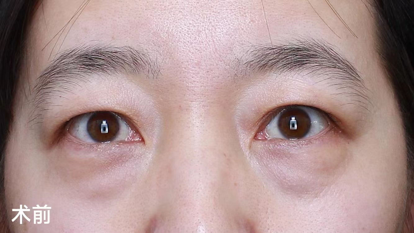 年轻人眼周衰老，对症下药这样做！
