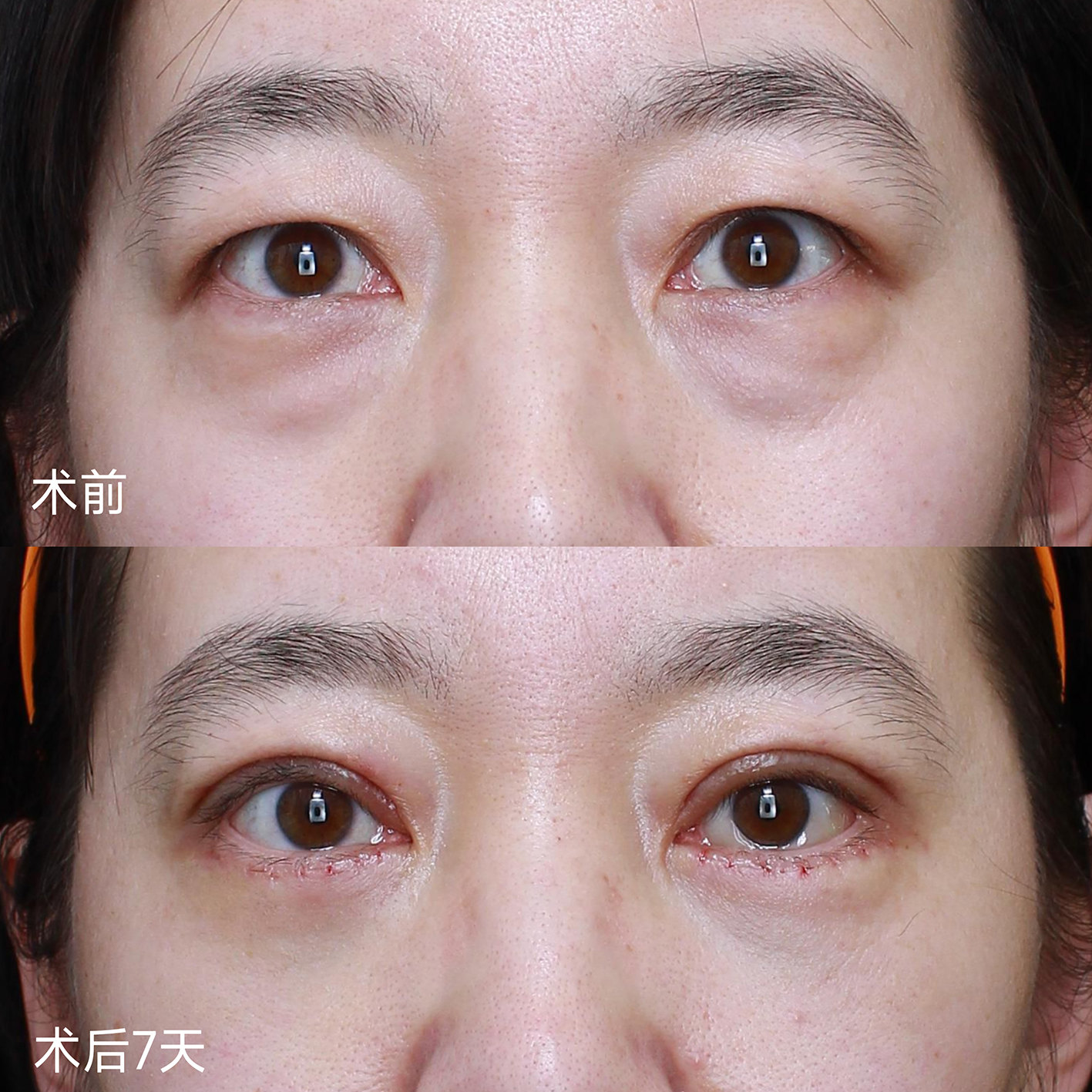 年轻人眼周衰老，对症下药这样做！