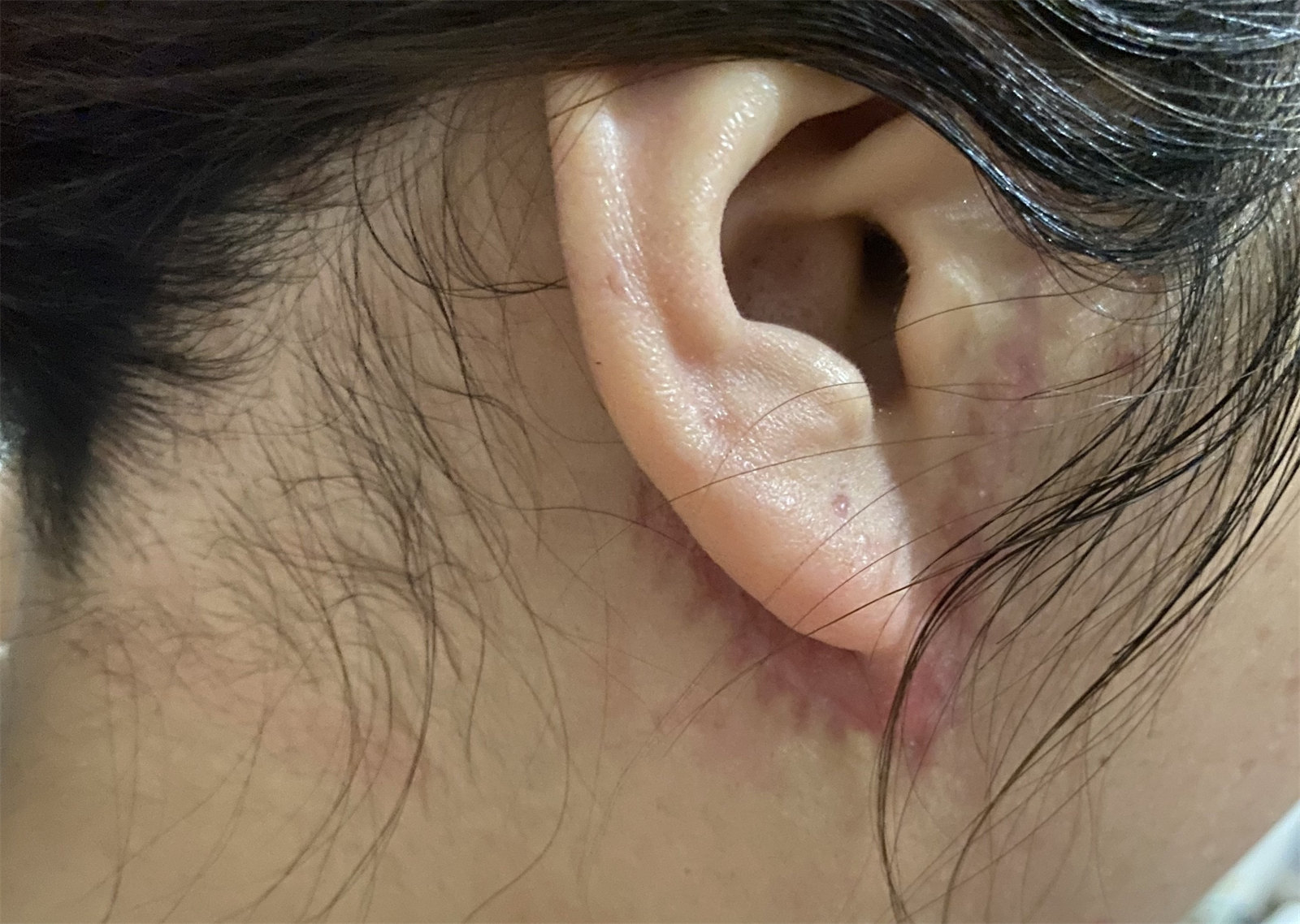 医美小白做拉皮手术前，应如何正确避坑？