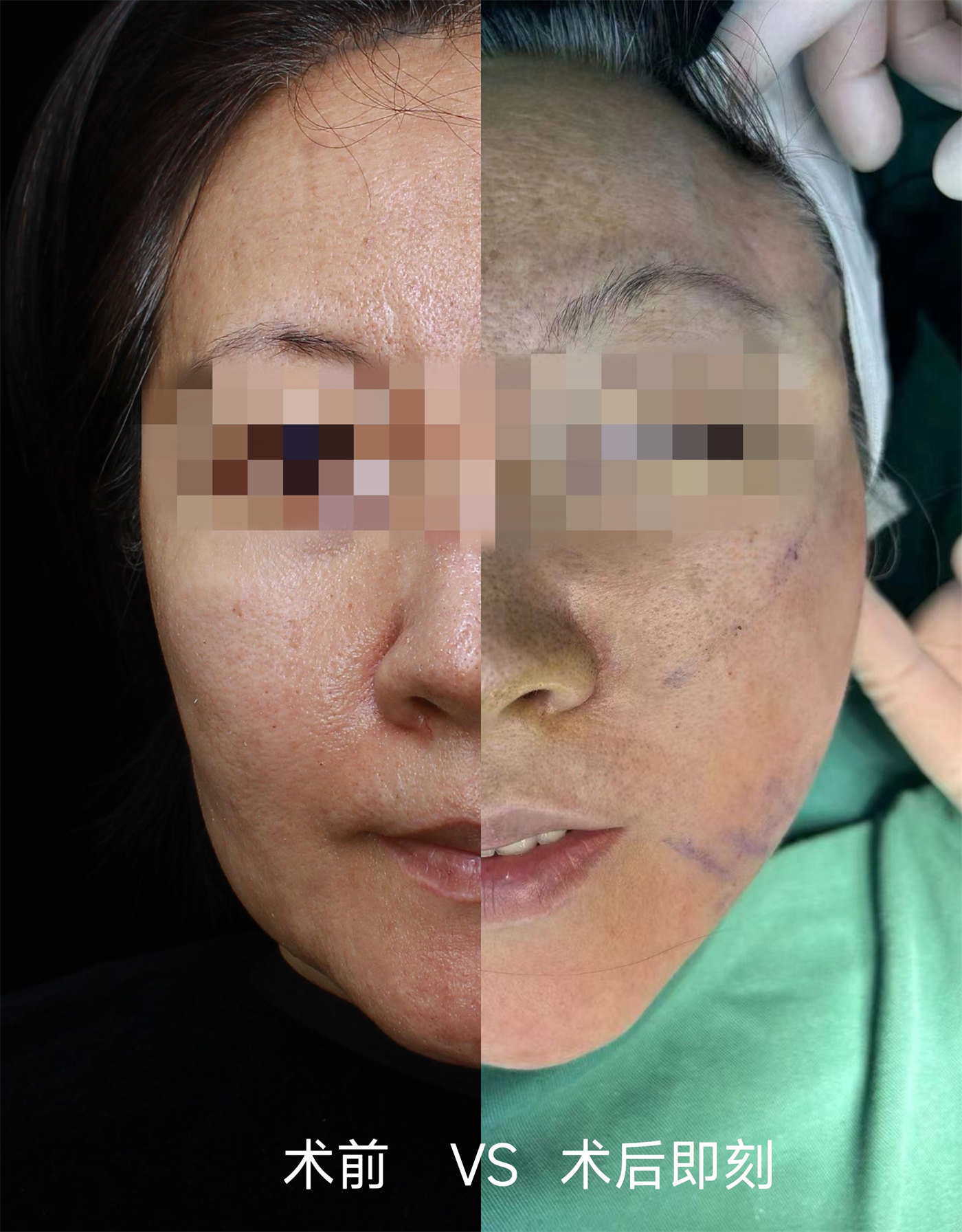 53岁选择做了拉皮手术，迎来了迟到10年的逆龄之旅