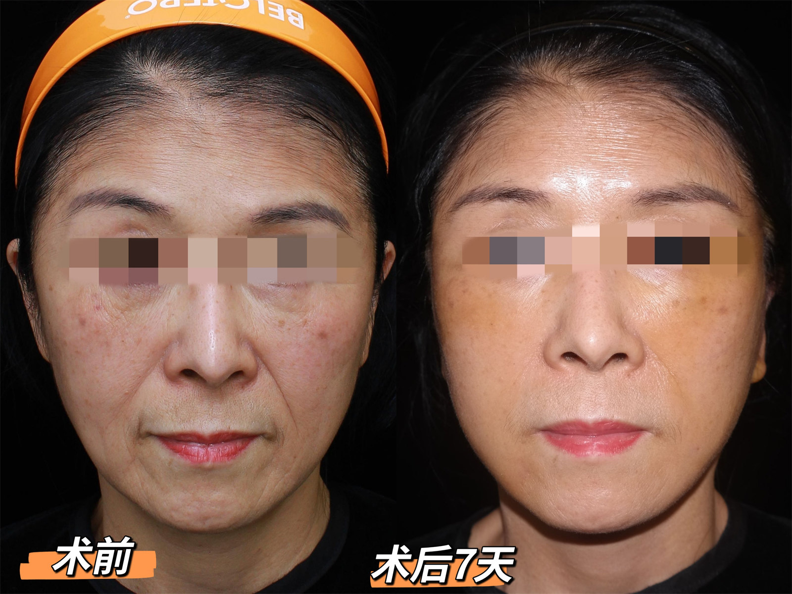 60岁做了拉皮手术，术后7天“大变样”！