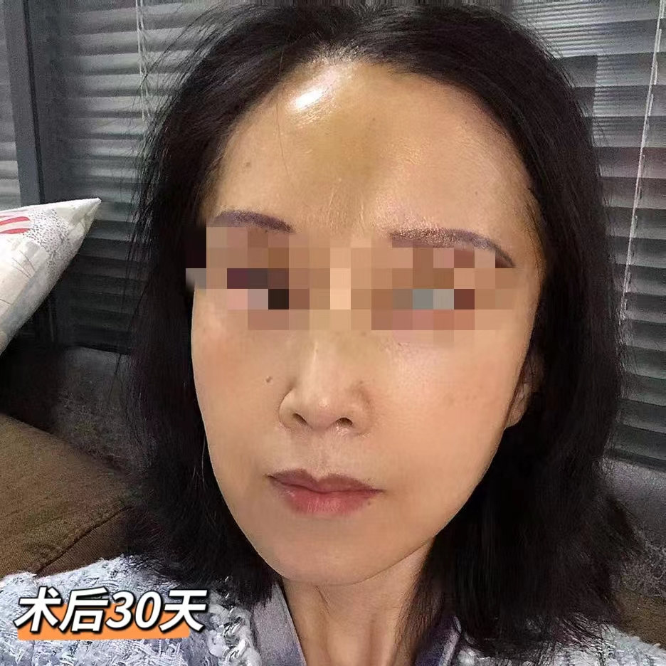 案例日记|53岁艺术院校教师，拉皮术后直接减龄15岁