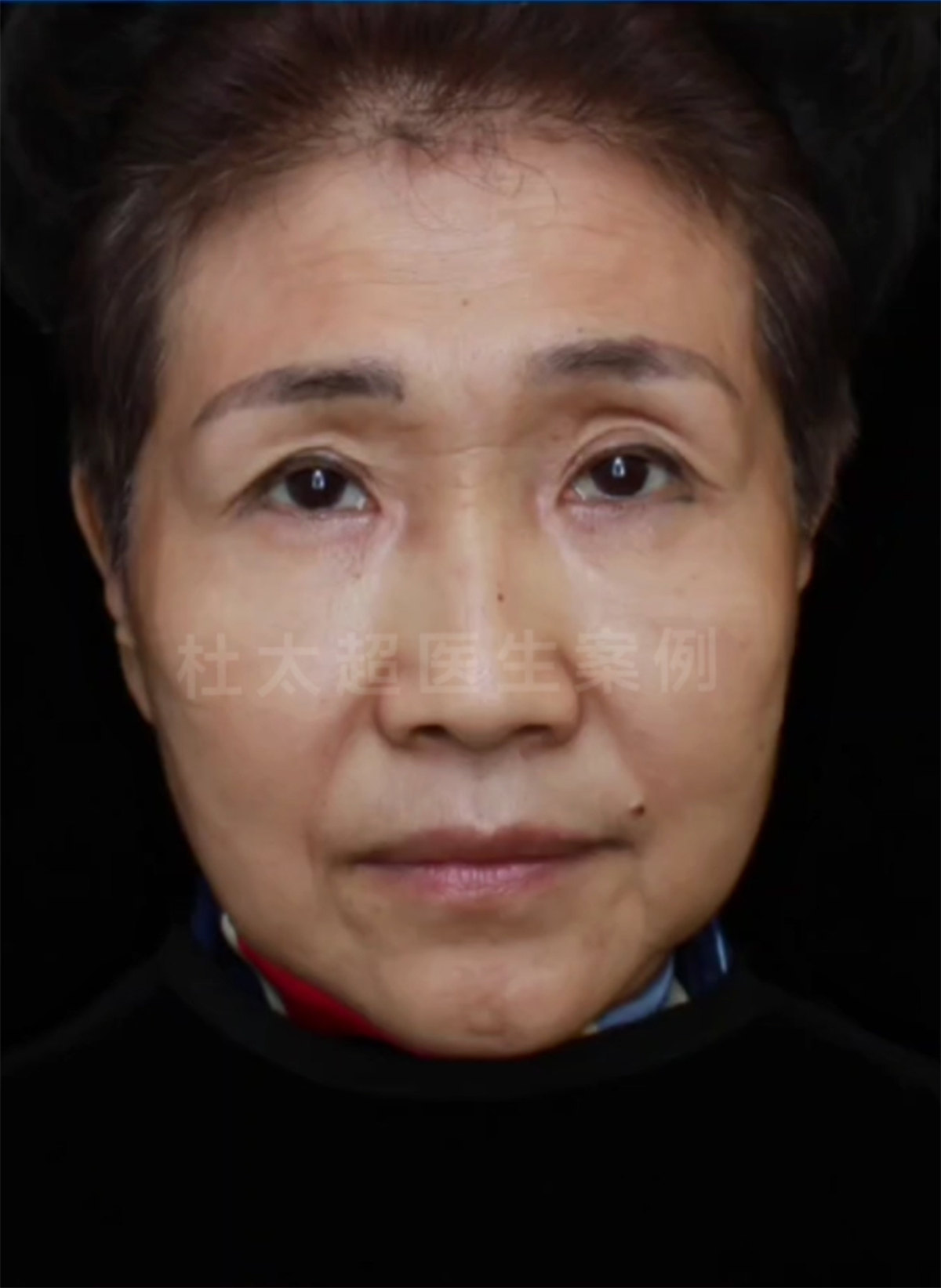 拉皮效果太好了，4个月后又做了去眼袋和眼皮提升，太赞了！