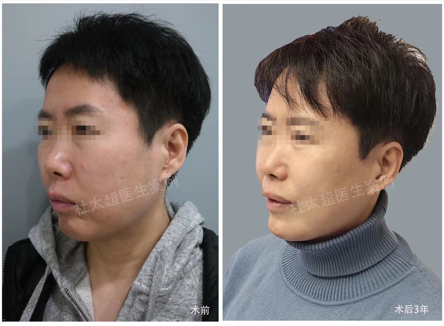 迈过50岁笔直大关的我：如何借由杜太超教授的专业技术，成功挽回落寞青春！