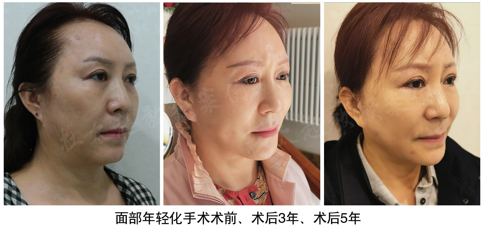 面部提升手术：太惊讶了！5年后她竟然还如此年轻！