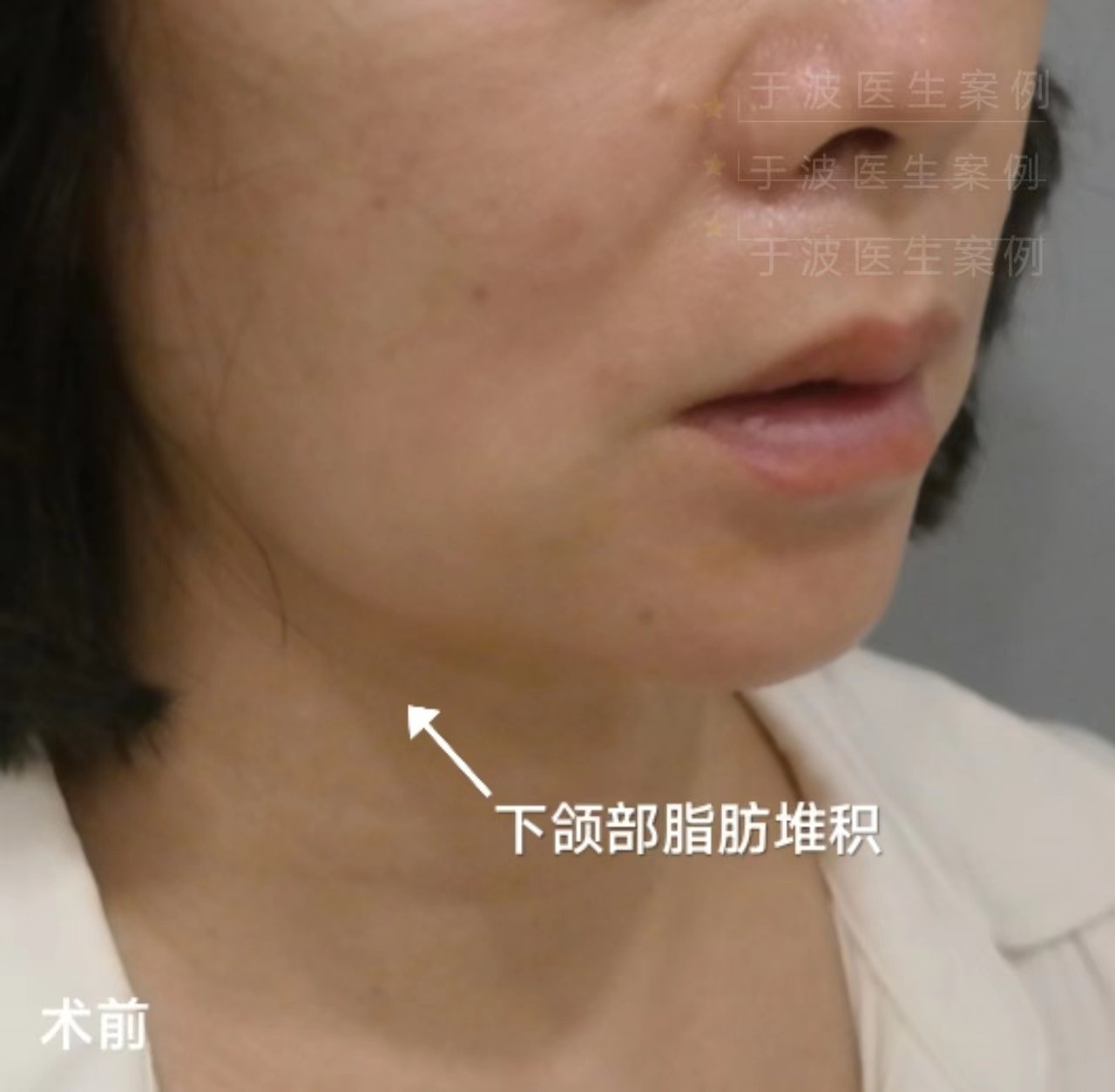 钻石精雕打造少女线术后1个月分享！