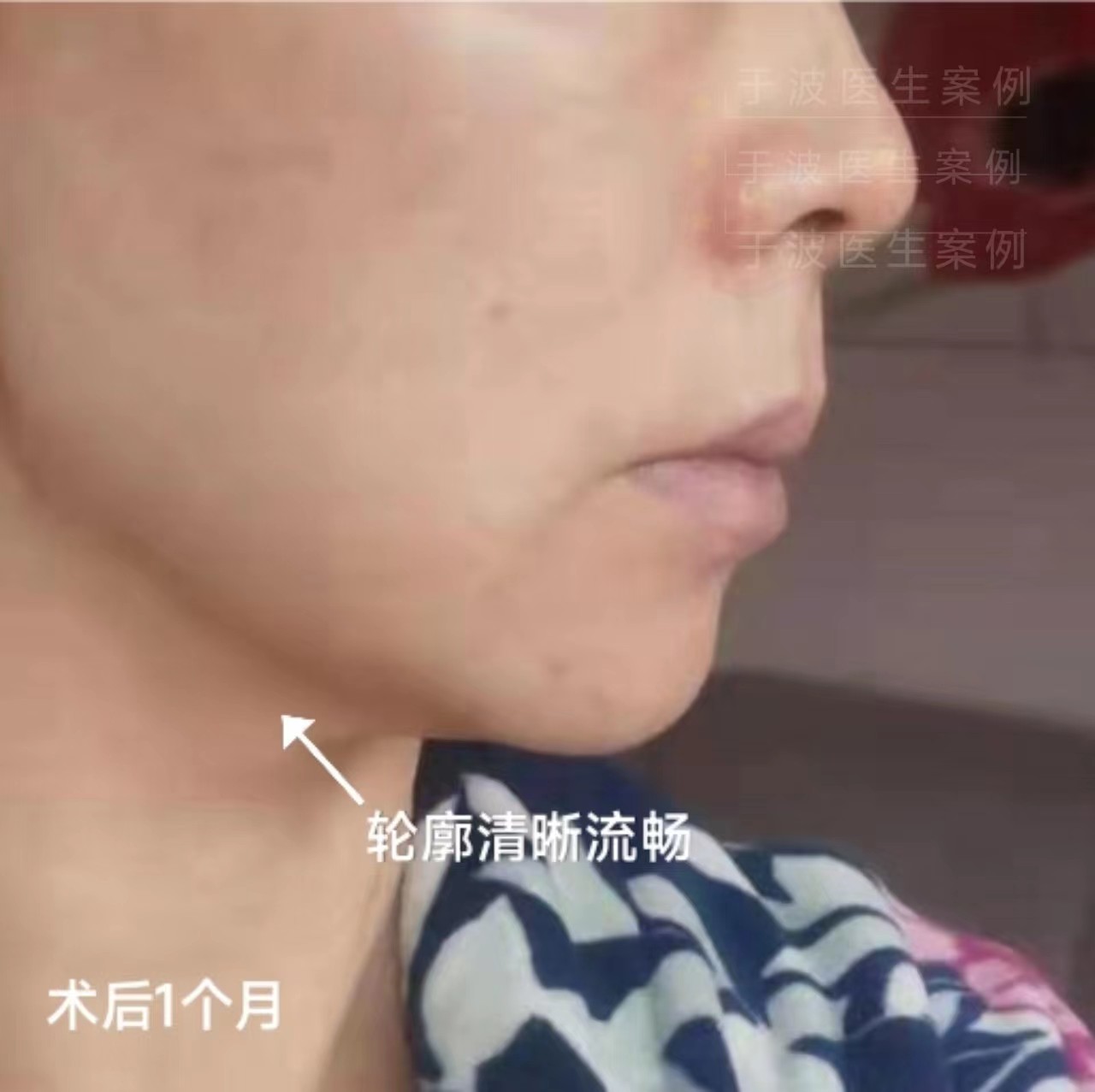 钻石精雕打造少女线术后1个月分享！
