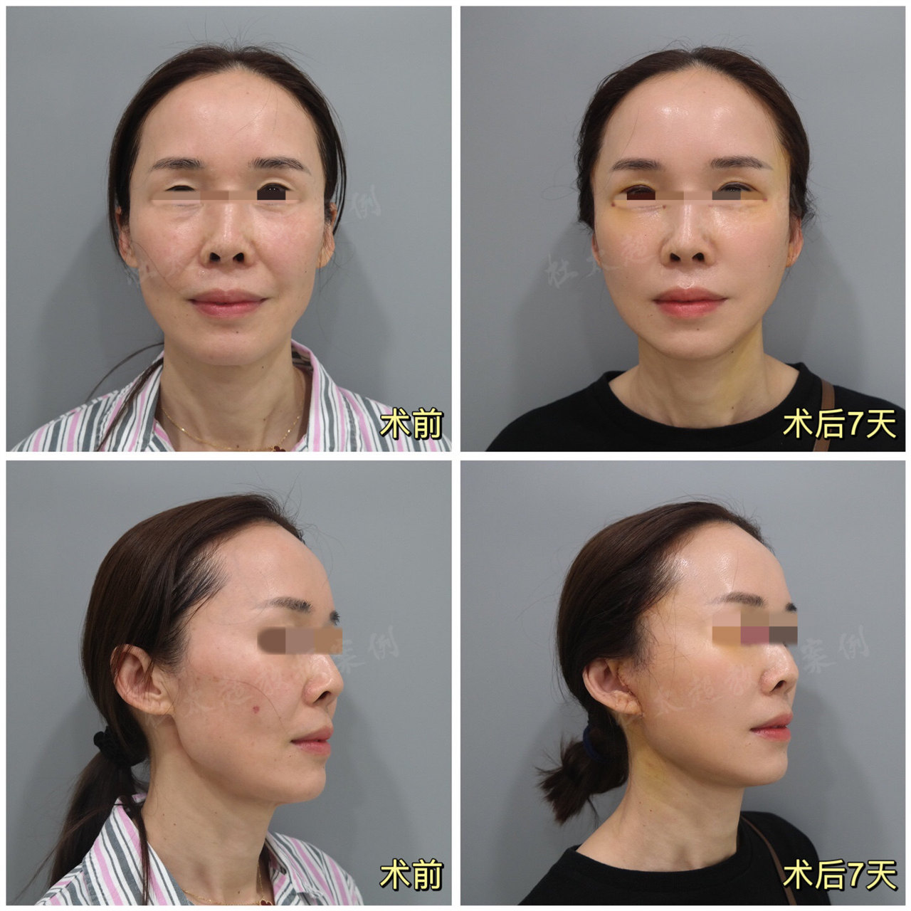 48岁女士，为挽回丈夫的瞩目不惜做拉皮手术！结果太让人意外了！