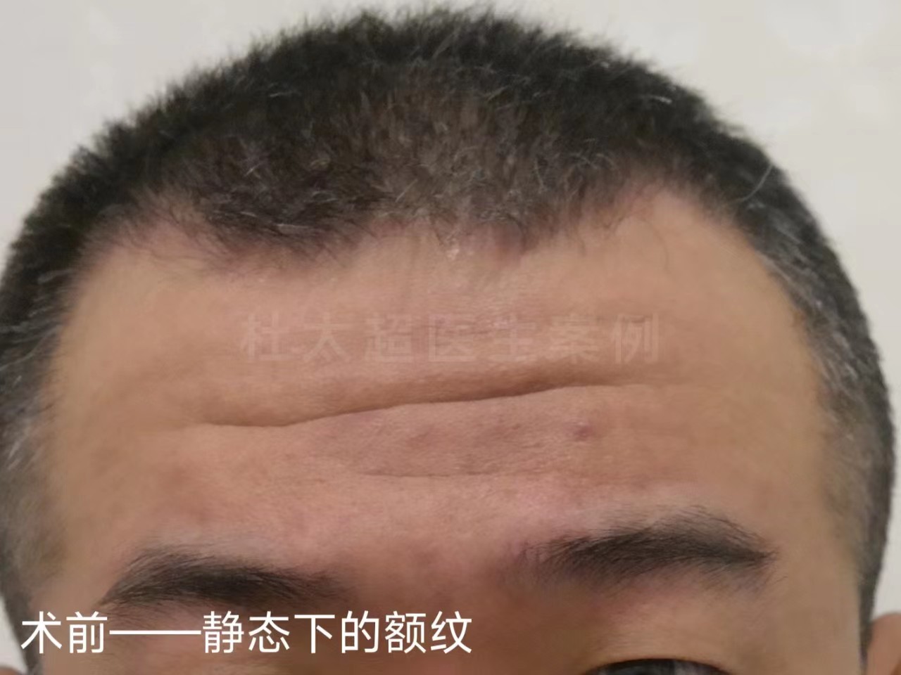 男士额纹深邃，不接受大切口除皱，这样做有效改善！