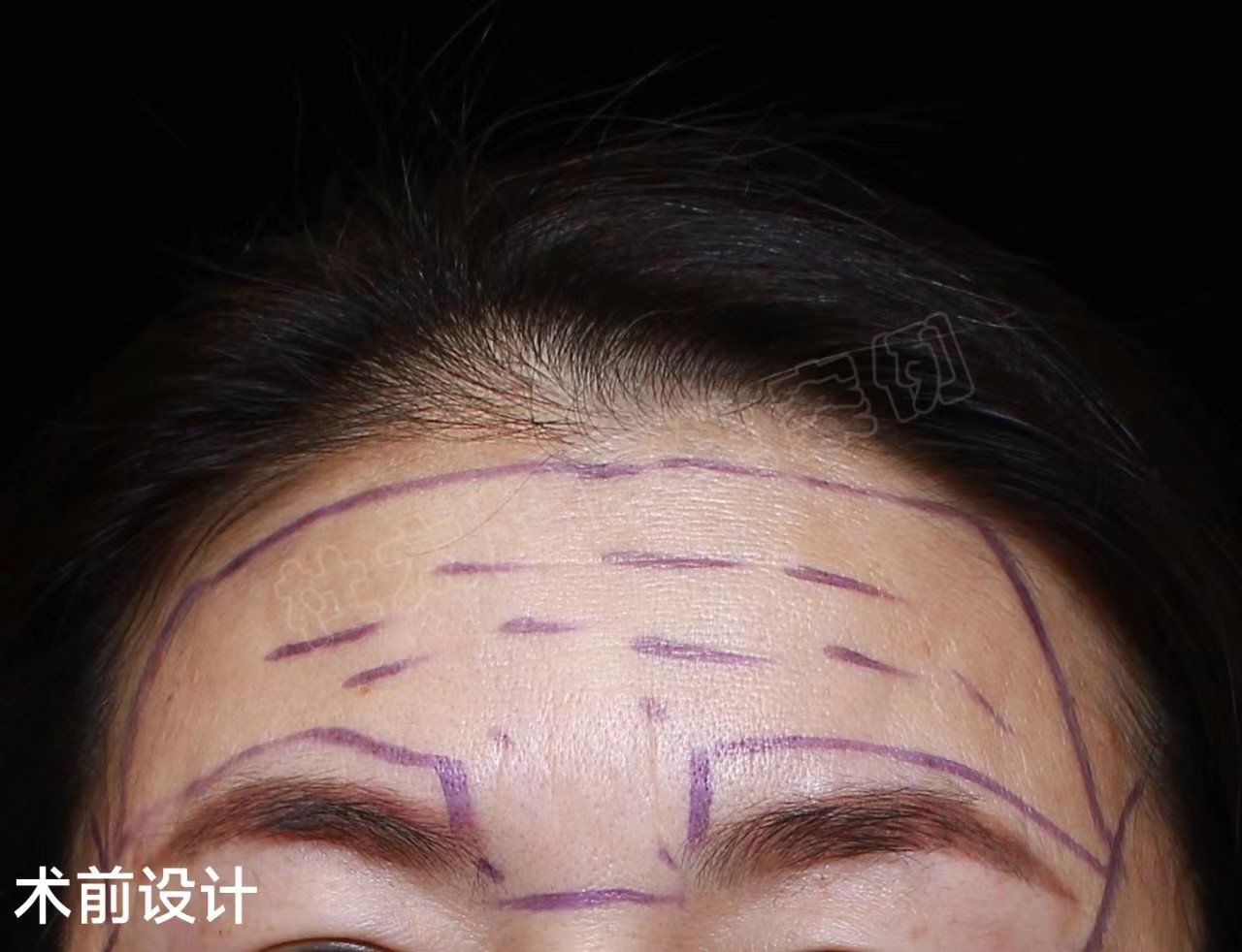 49岁女士做额部除皱，分享让“山川”变“平原”的秘密！