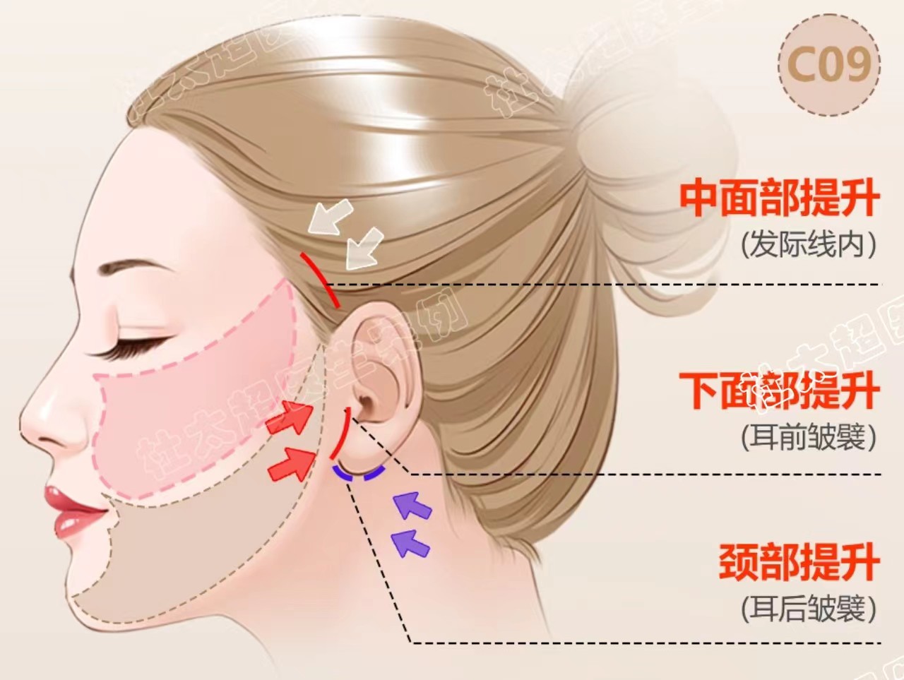 拉皮案例真实分享|术后效果肉眼可见