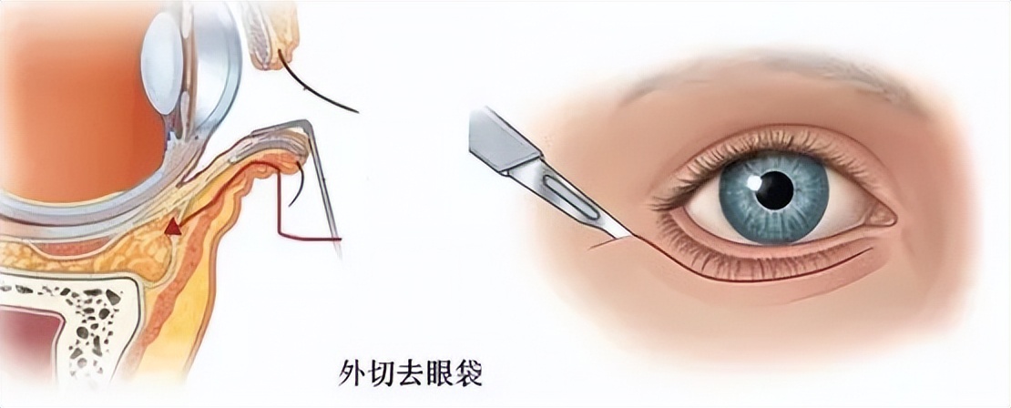 28岁做“眼袋手术”都说早，看完效果都说“好”
