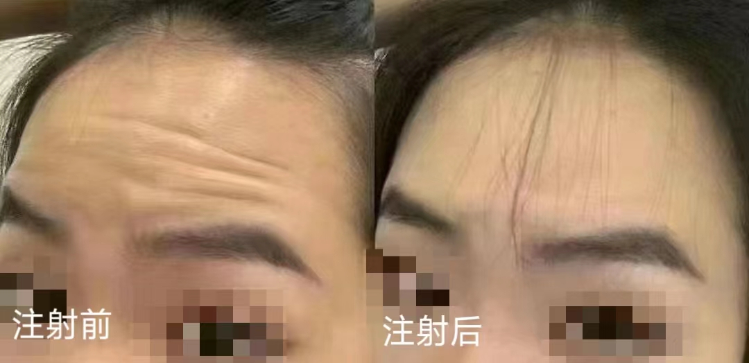 三种额纹去除方法公示，第3种适应症最广