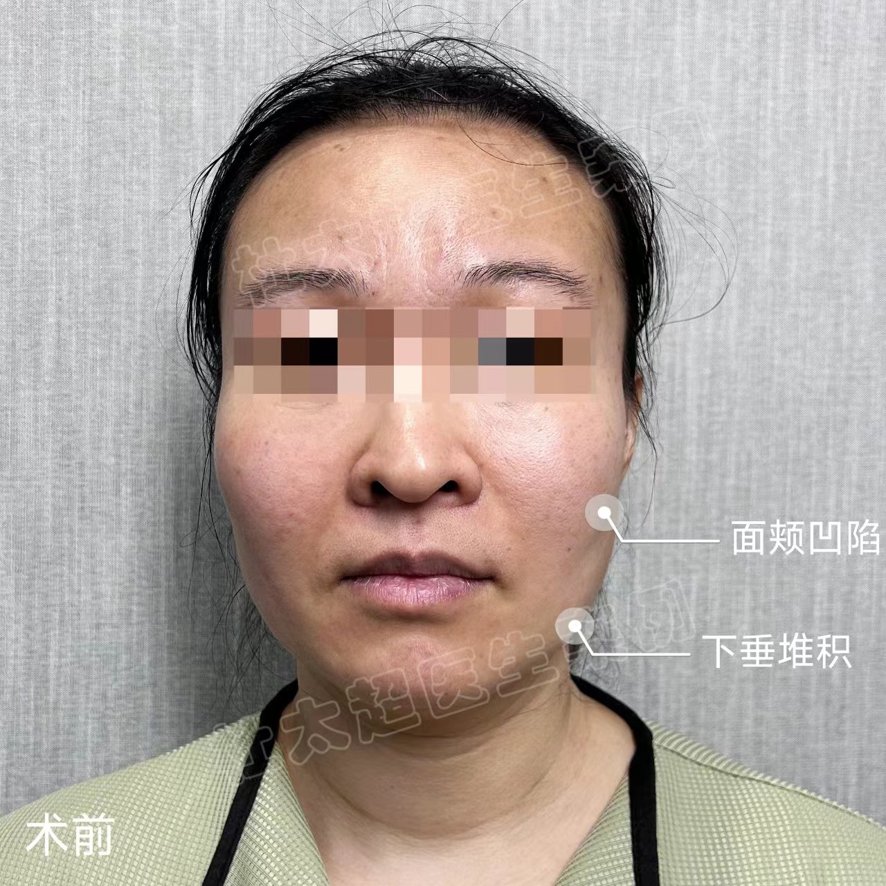 想年轻一些，但不想变化太大，医生为我这样设计