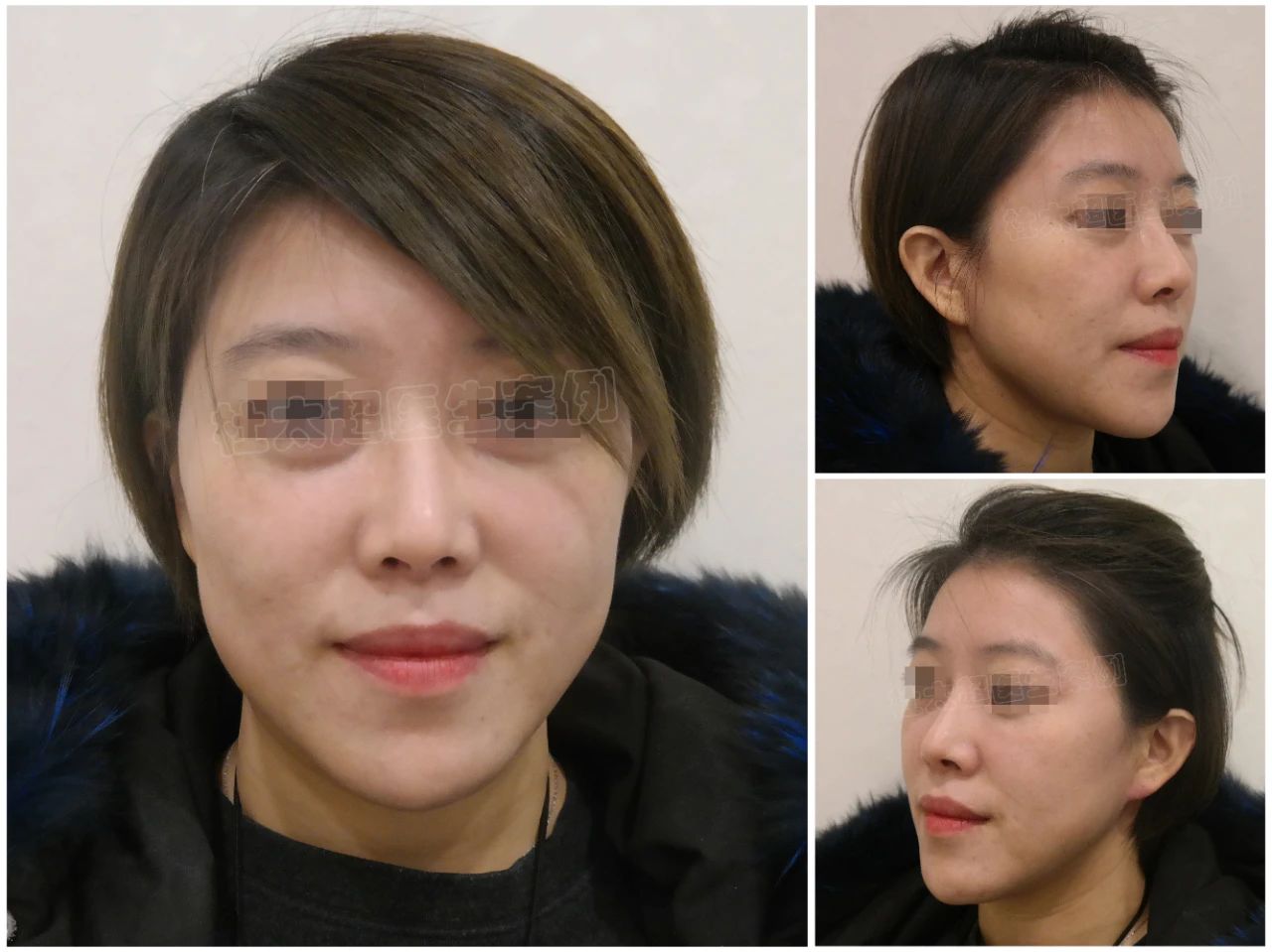 39岁女士caw小切口面部紧缩术术后5个月深度分析