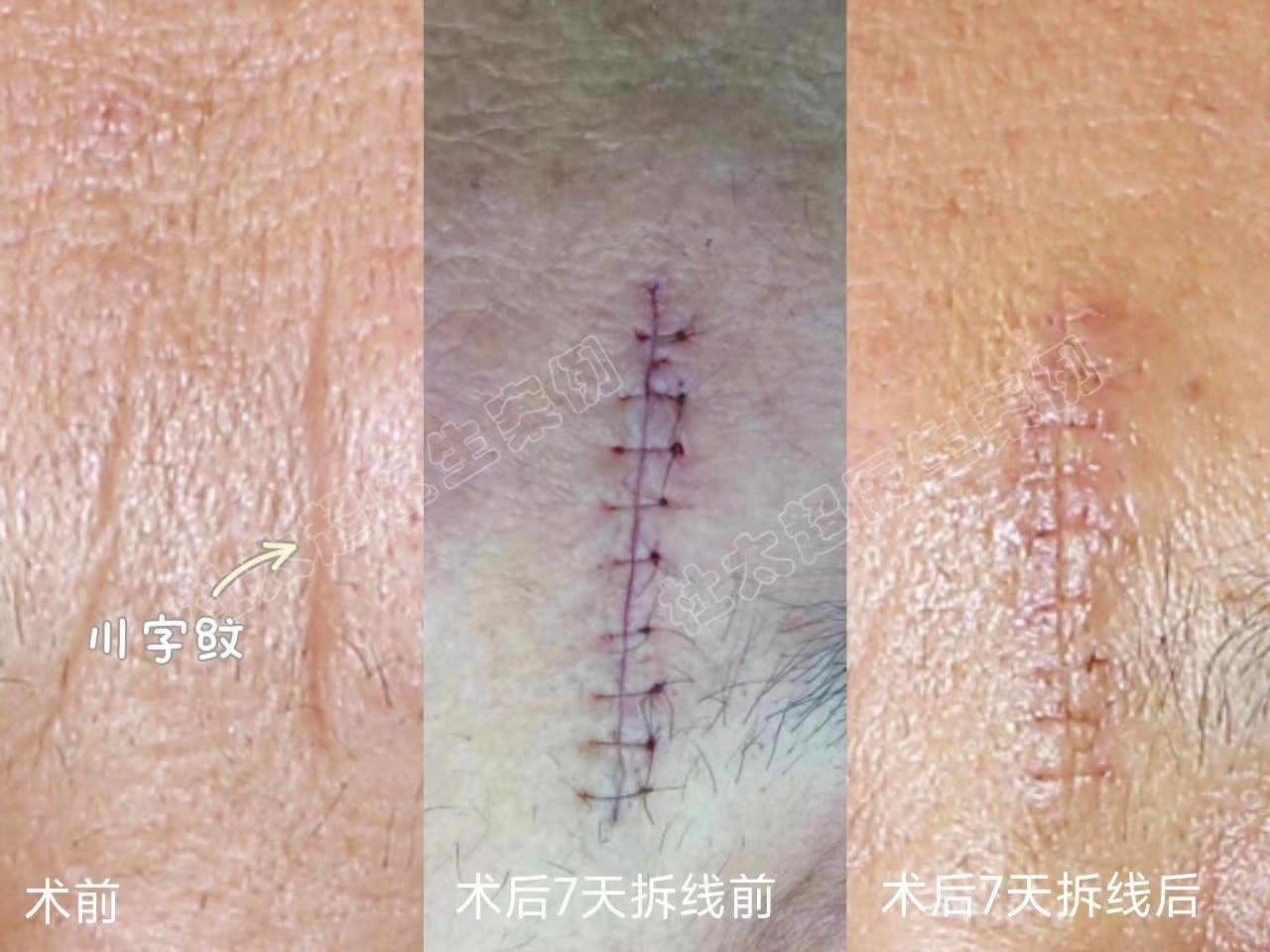 川字纹影响面相，想要去除，方法全在这了!
