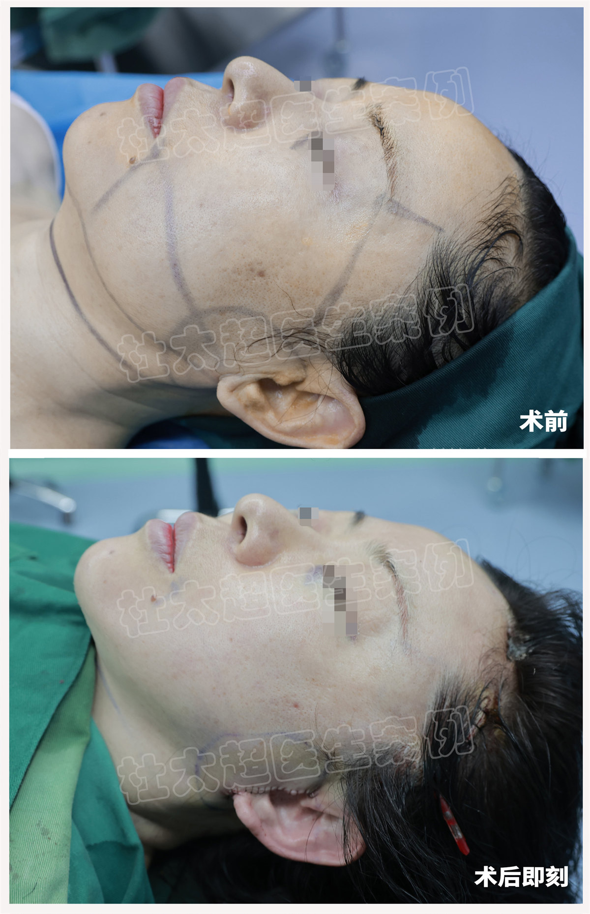 拉皮术后看到镜中的自己，难以掩盖想要分享的心